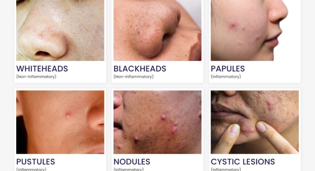 “Different types of acne shown on skin including whiteheads, blackheads, papules, pustules, nodules, and cystic lesions with close-up facial examples”