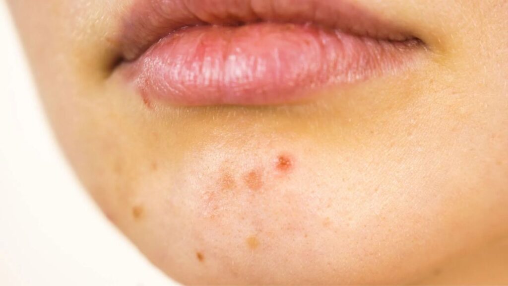 Acne on chin visible in close-up skincare dermatology image