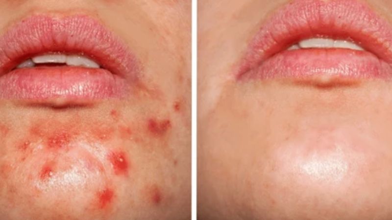 Acne on chin before and after treatment results showing clear skin