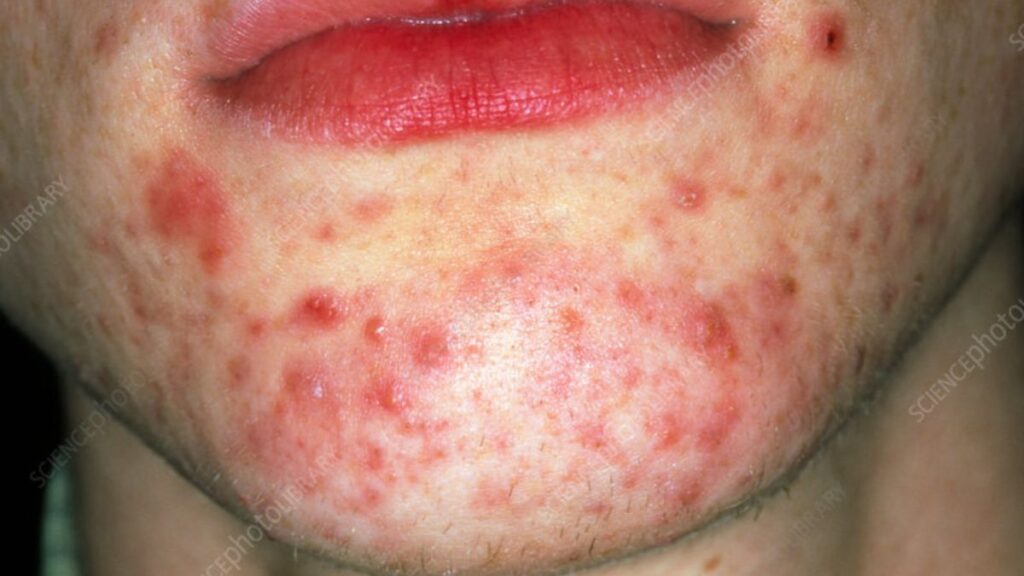 Severe inflammatory acne on chin and lower face area