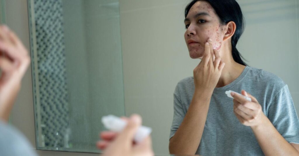 common mistakes in skin care with acne like popping pimples