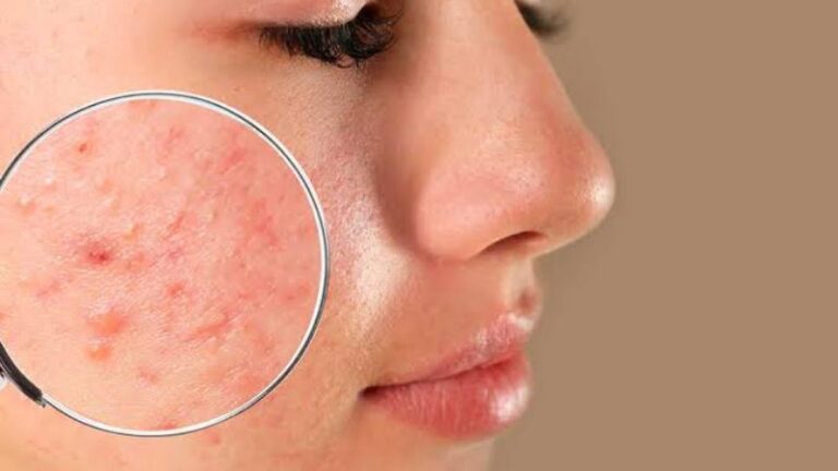 “Close-up view of bacterial acne on skin showing red inflamed pimples and infected pores.”