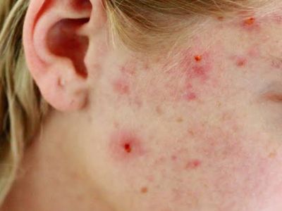 “Skin condition showing bacterial acne with painful red bumps and pus-filled lesions.”