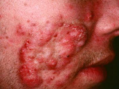 Pus-filled pimples and irritated facial skin