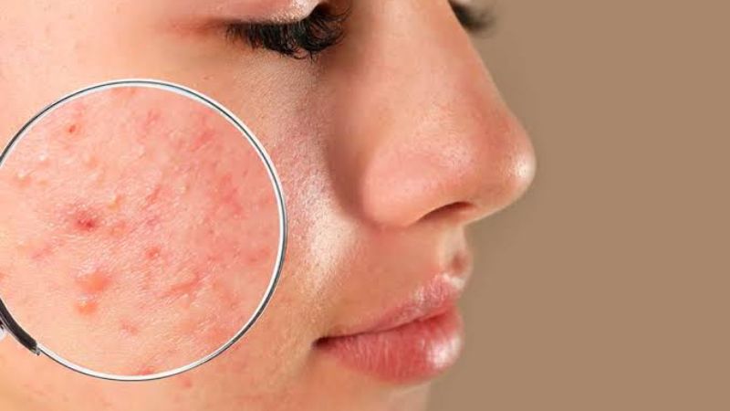 “Close-up view of bacterial acne on skin showing red inflamed pimples and infected pores.”