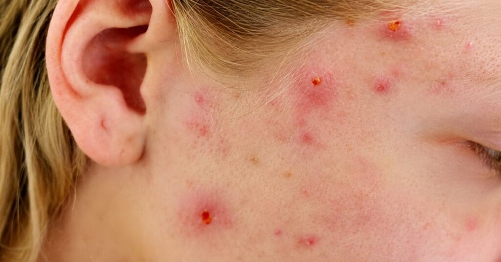 Close-up of bacterial acne on facial skin showing redness, inflammation, and pimples with skincare treatment concept.
