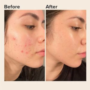 “Before and after comparison of acne-prone skin showing excess oil, clogged pores, and breakouts before using toner, and clearer, smoother, and more balanced skin after toner use with reduced acne and refined pores.”