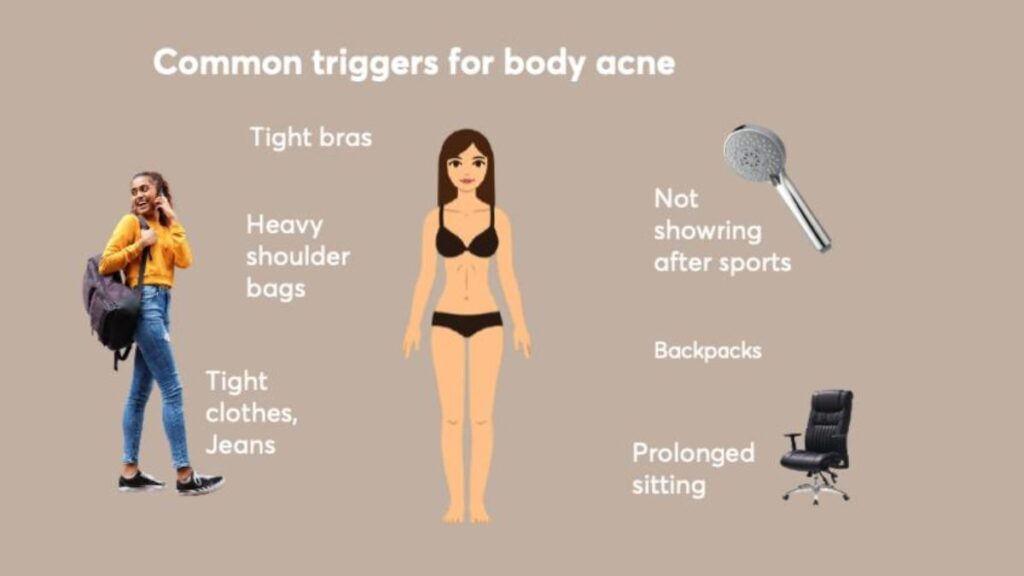 best clothing choices to prevent and reduce acne