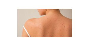 body acne close up on back and shoulder with visible pimples and skin texture