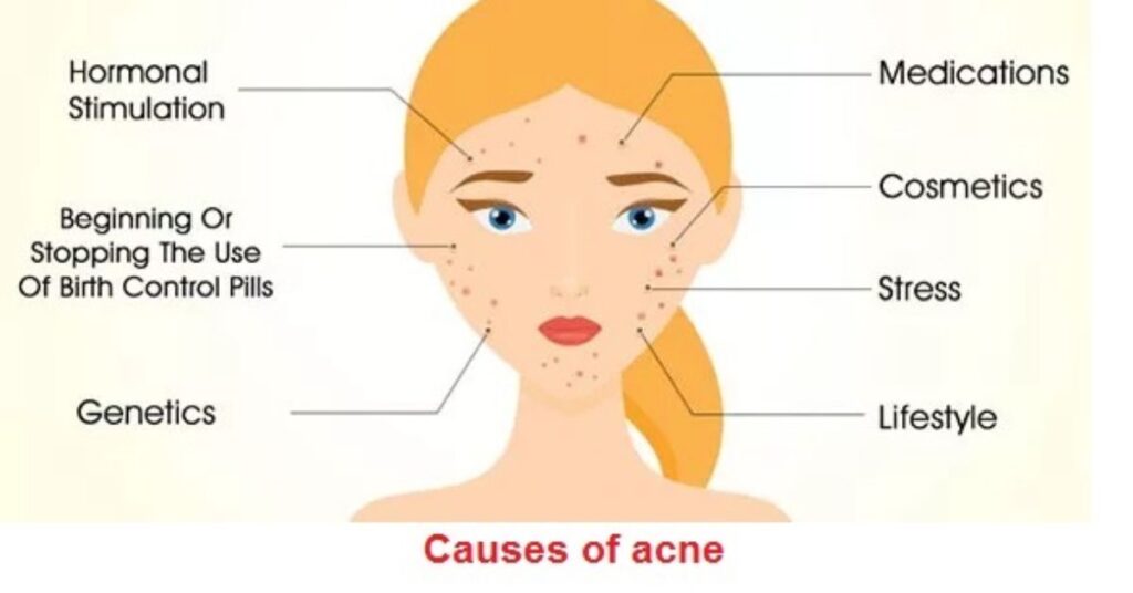 : acne causes showing clogged pores oil and bacteria on skin