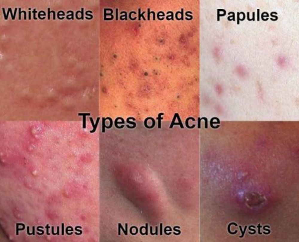 "Comparison chart of various chest acne types like whiteheads, blackheads, and cystic acne."
