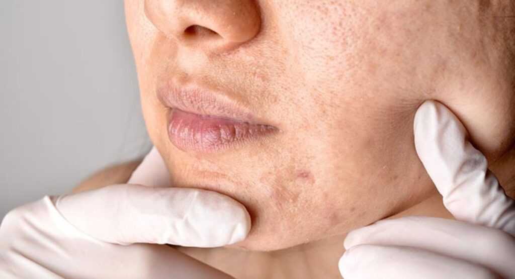 Close-up of facial skin with mildly clogged pores and skincare products