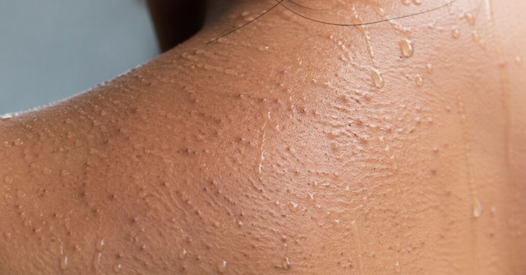clogged pores causing shoulder acne due to sweat and oil
