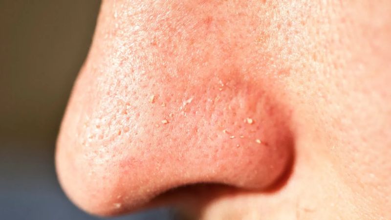 “Close-up of nose with visible blackheads, enlarged pores, and mild redness on acne-prone skin”