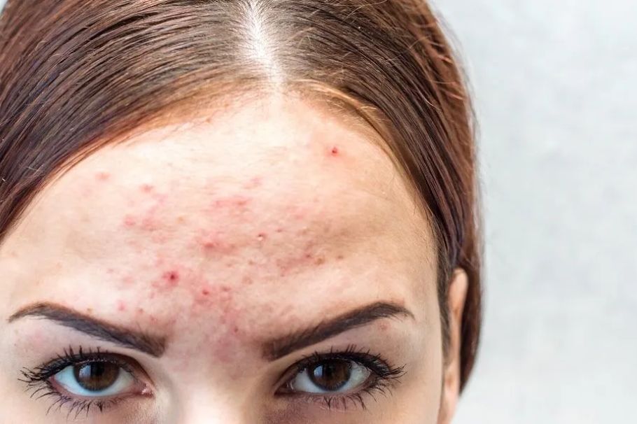 "Close-up of forehead acne with visible pimples and clogged pores on oily skin"