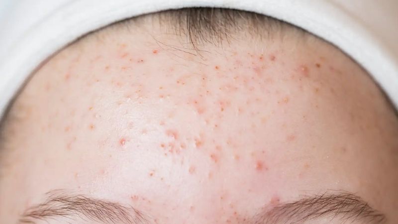 “Forehead acne showing pimples and breakouts on skin caused by clogged pores and excess oil”