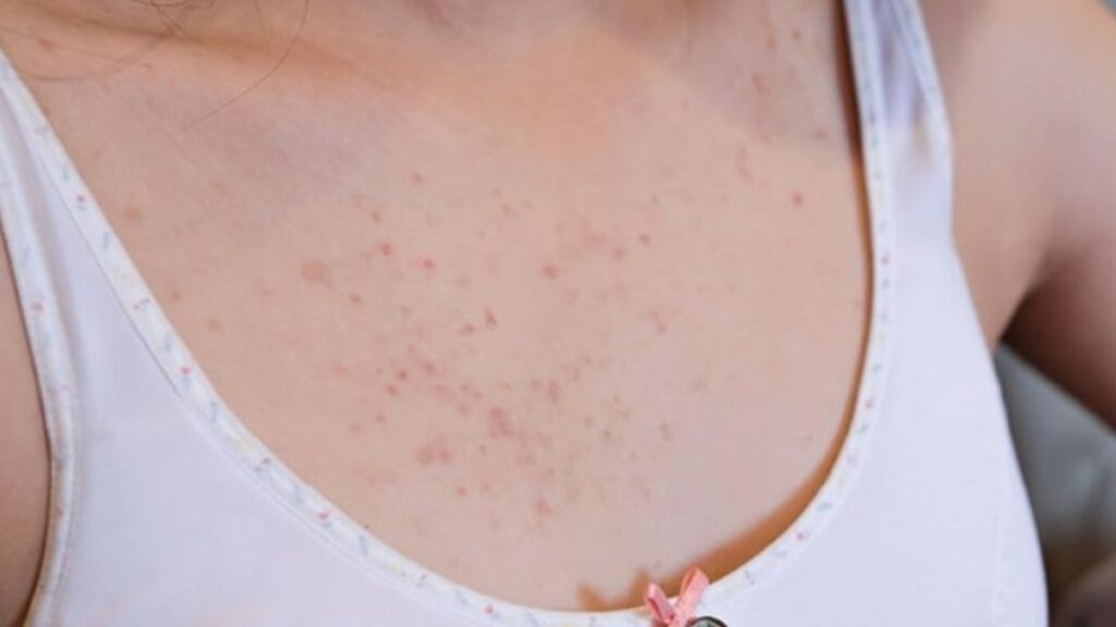 how to get rid of chest acne fast with visible before and after results