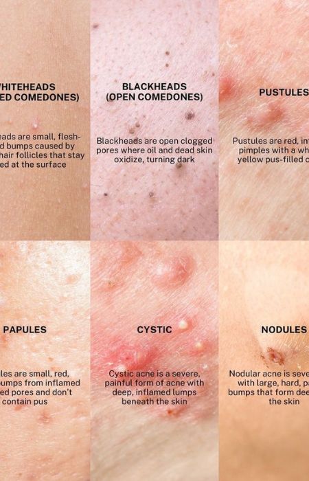 “Illustration showing main causes of bacterial acne including clogged pores, excess oil, and bacterial growth on skin”
