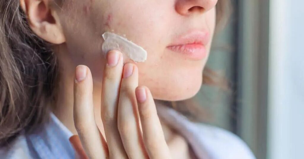 skin care with acne products to avoid like oily creams and makeup