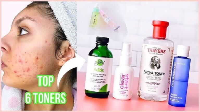 Best toner for acne prone skin showing clear skin improvement before and after use, oil control and reduced acne