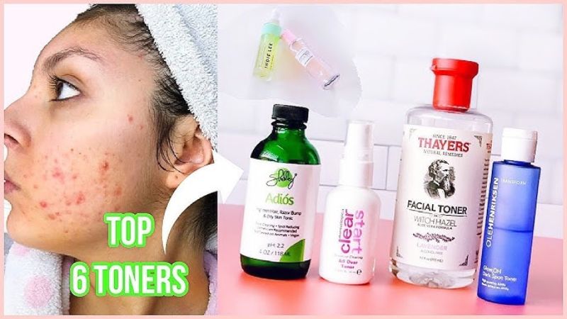 Best toner for acne prone skin showing clear skin improvement before and after use, oil control and reduced acne