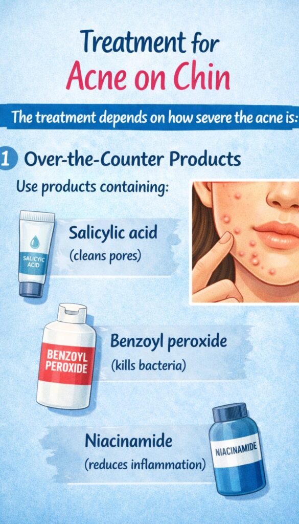 “Acne on chin treatment with salicylic acid, benzoyl peroxide and niacinamide”