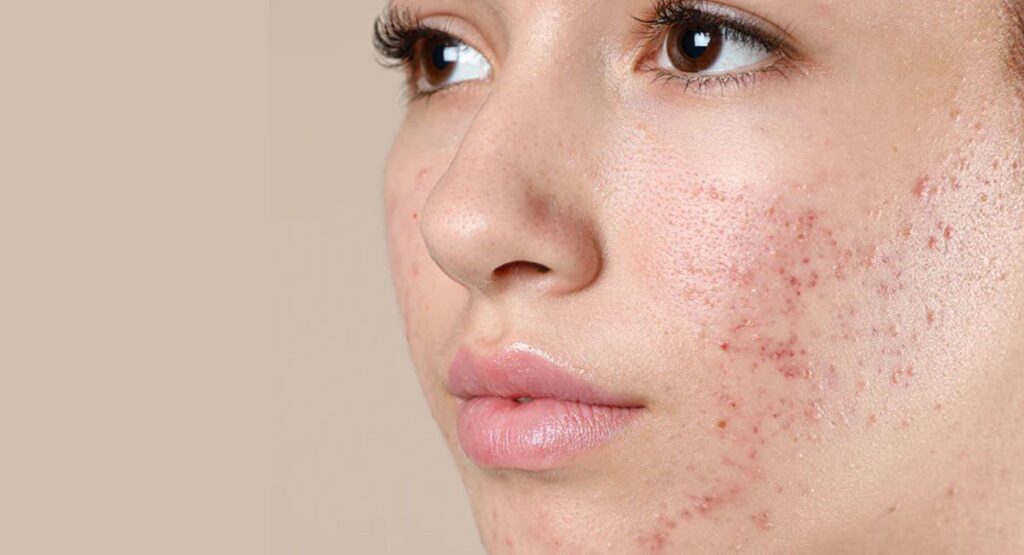 Understanding Acne-Prone Skin: Causes and Care Guide