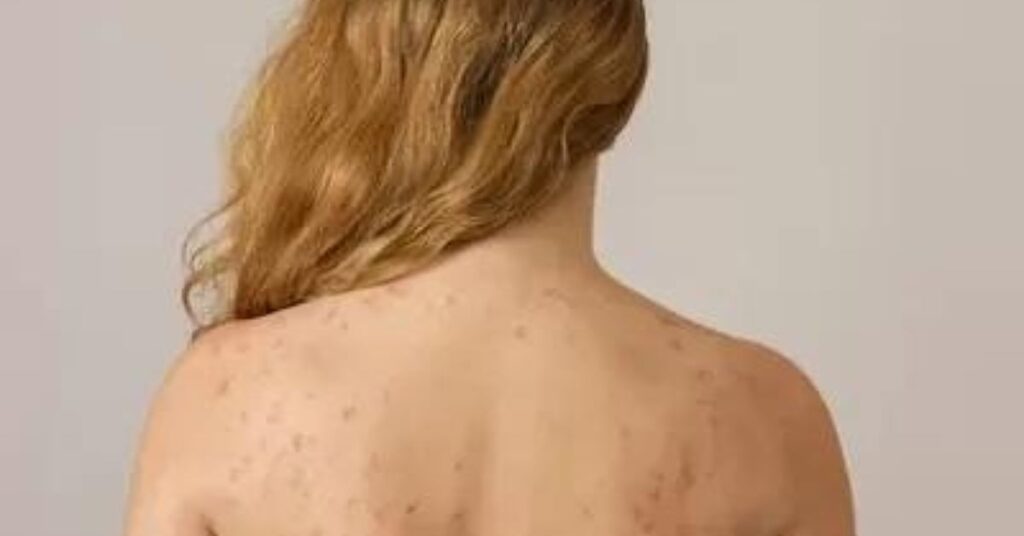 what causes back acne in females on shoulder skin