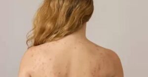 what causes back acne in females on shoulder skin