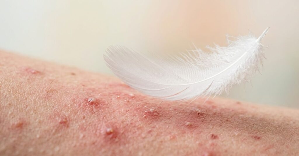 Why do spots hurt feather above acne skin showing pain and healing