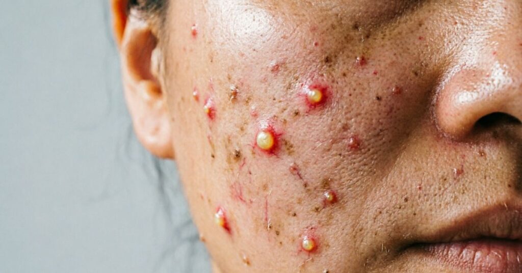 Why do spots hurt feather floating above inflamed acne skin showing healing from painful spots