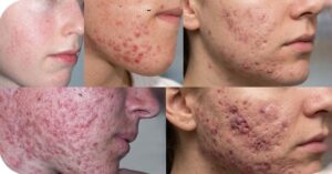 Acne on cheeks meaning dermatology close-up skin with mild acne