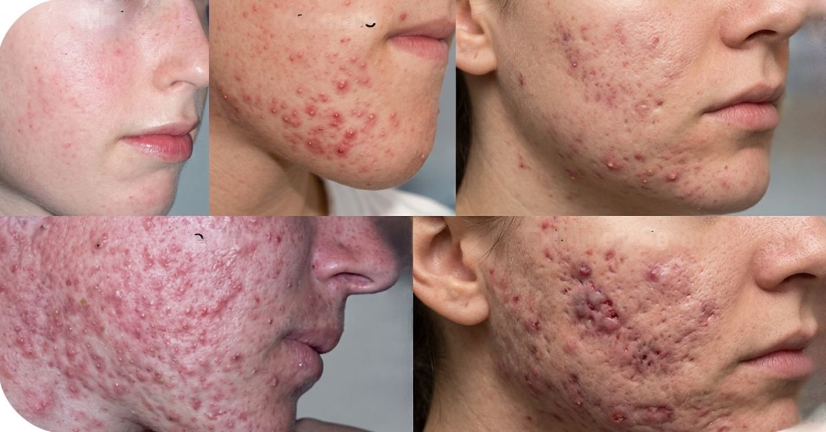 Acne on cheeks meaning dermatology close-up skin with mild acne