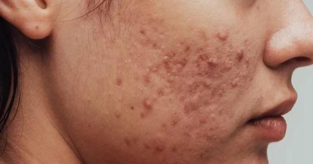 acne on cheeks meaning ultimate guide close up dermatology skin with mild acne