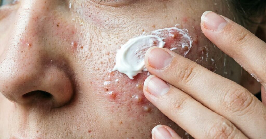Acne prone skin with visible pores and redness in natural lighting