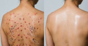 back acne causes comparison showing acne vs clear skin