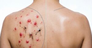 back acne causes before and after treatment illustration showing pimples clogged pores and clear skin results