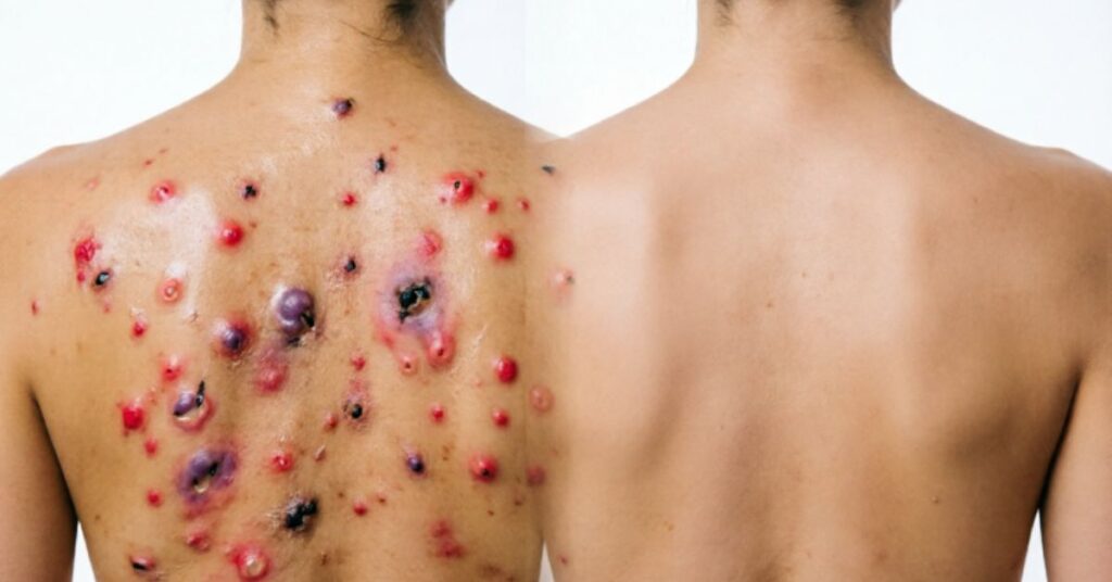 Back Acne Causes: Complete Guide to Clear Skin back acne causes infographic showing oil hormones sweat diet stress and clogged pores on human back