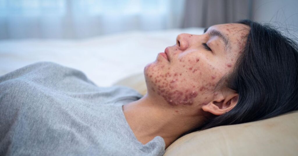 stress and lack of sleep effect on acne on cheeks meaning skin breakouts