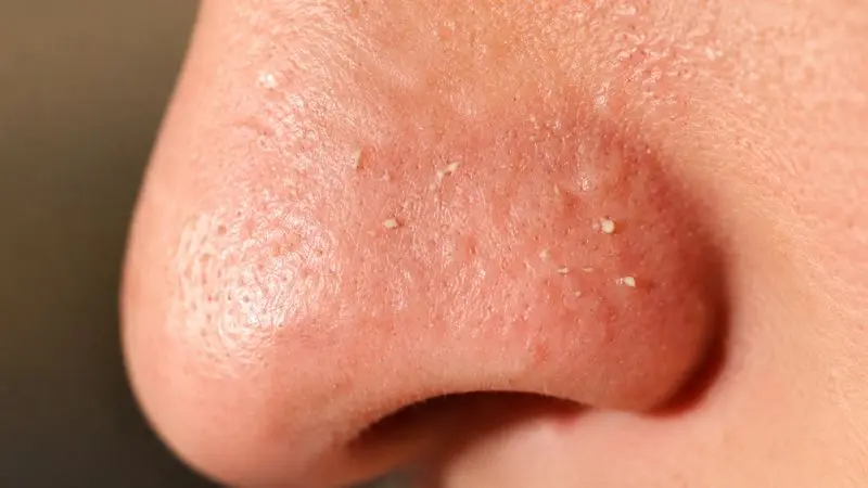 Macro close-up of a young woman's nose showing clogged pores, enlarged pores, and blackheads that can contribute to acne breakouts.