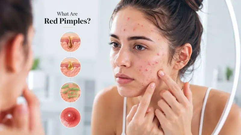 Woman examining red pimples caused by clogged pores, excess oil, and skin inflammation.